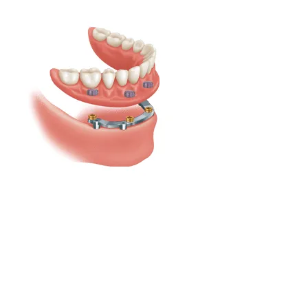 Chatham Kent implant dentures: The permanent modern approach to restoration of your smile