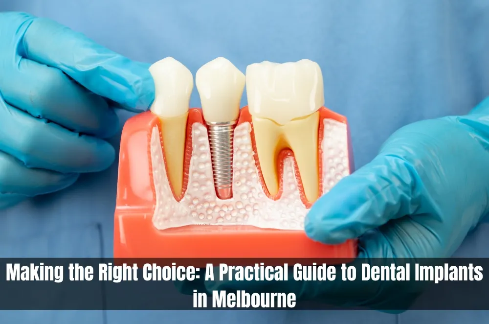 Making the Right Choice: A Practical Guide to Dental Implants in Melbourne