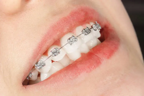 Modern Smile Alignment Options in New Canaan: What Patients Should Know
