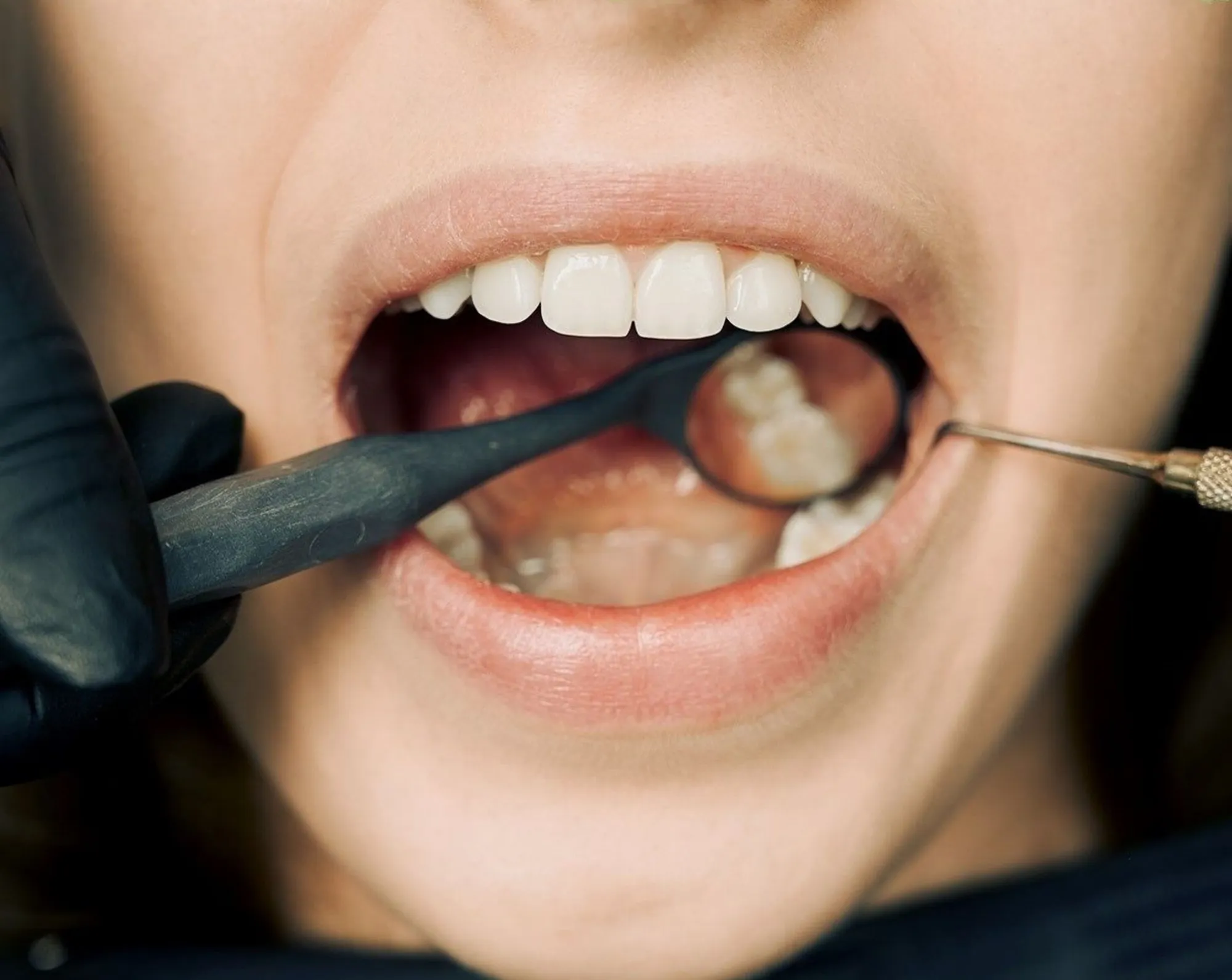 Why Prompt Bleeding Gums Treatment Is Essential for Oral Health