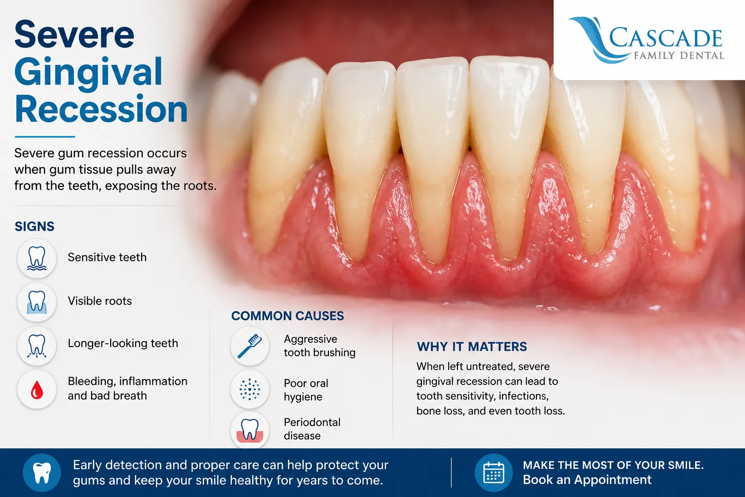 Severe Gingival Recession: Understanding the Causes, Signs, and Importance of Early Care