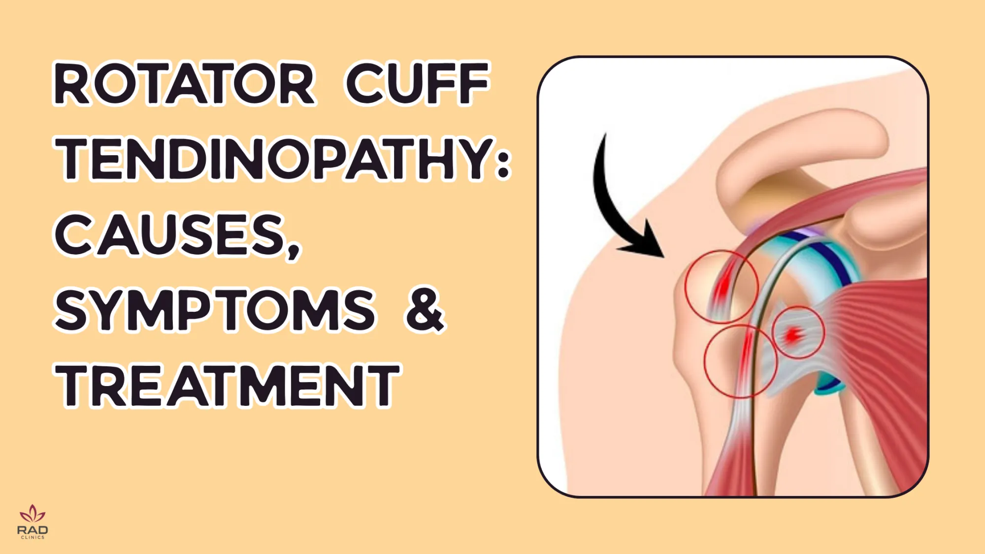 Rotator Cuff Tendinopathy: Causes, Symptoms & Treatment