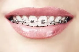 Everything You Need to Know Before Getting Braces in Waldo
