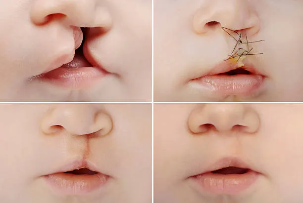 What Parents Should Know Before Cleft Palate Surgery