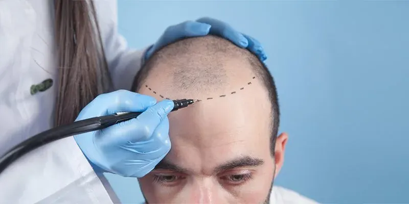The Ultimate Guide to Hair Implant Turkey Istanbul in 2026