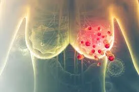 Breast Cancer: Symptoms, Types, Causes & Treatment