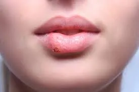 Lip Cancer: Symptoms and Causes