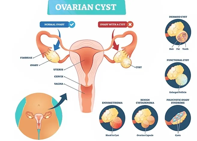What is the Cost of Ovarian Cancer Treatment in India?