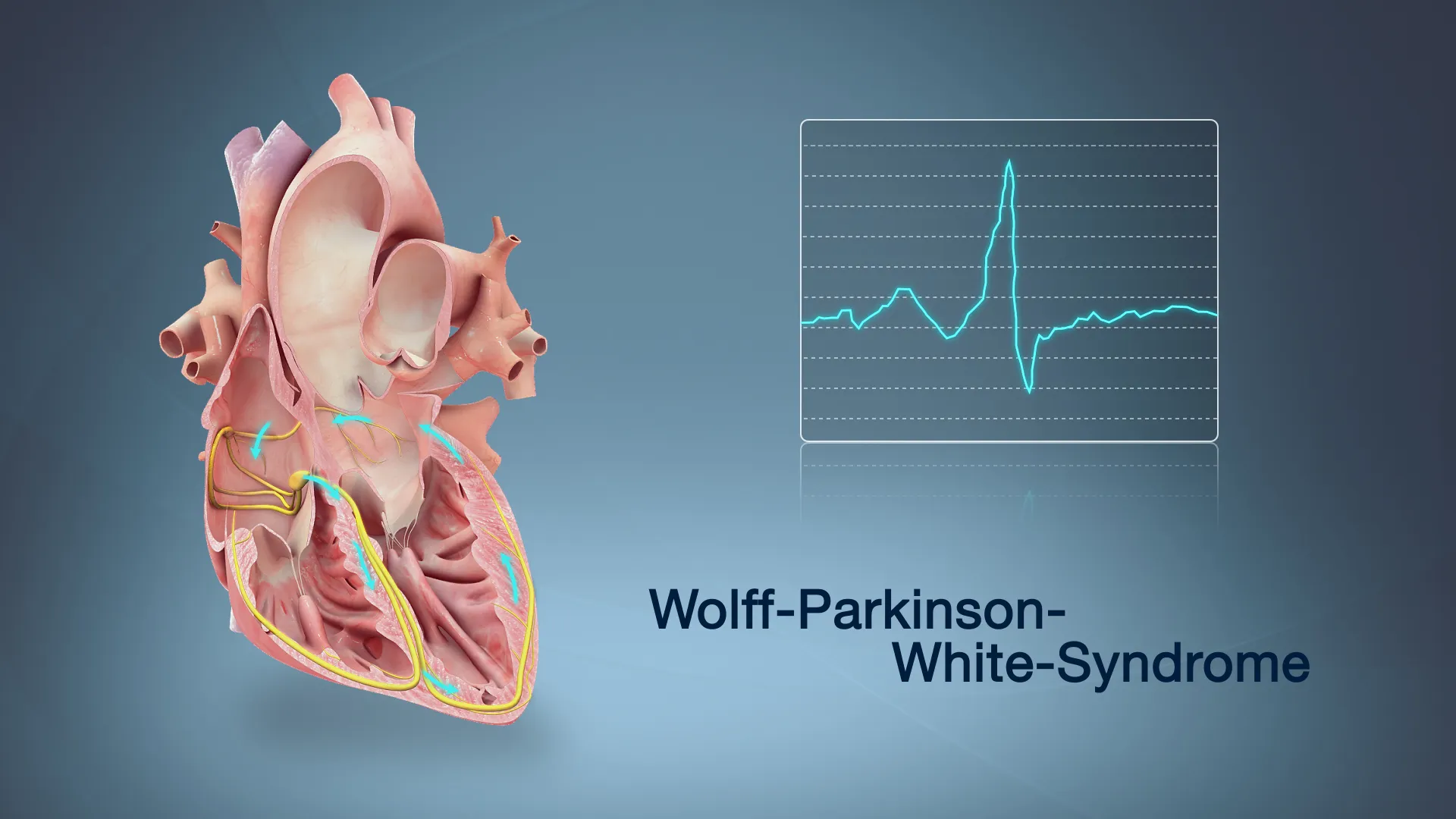 What Should You Know About Early Diagnosis and Effective Care for WPW Syndrome?