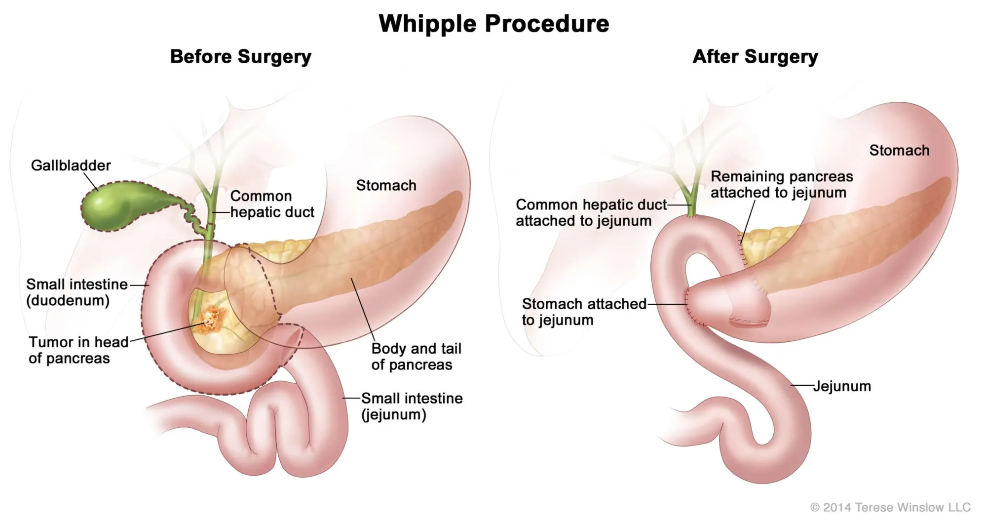 Whipple Surgery in India: Advanced Surgical Treatment for Pancreatic Cancer