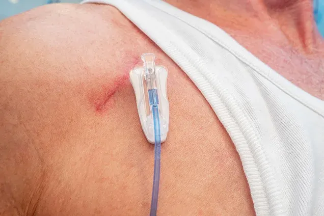 Chemo Port Insertion in India: A Safer and More Comfortable Way to Receive Chemotherapy