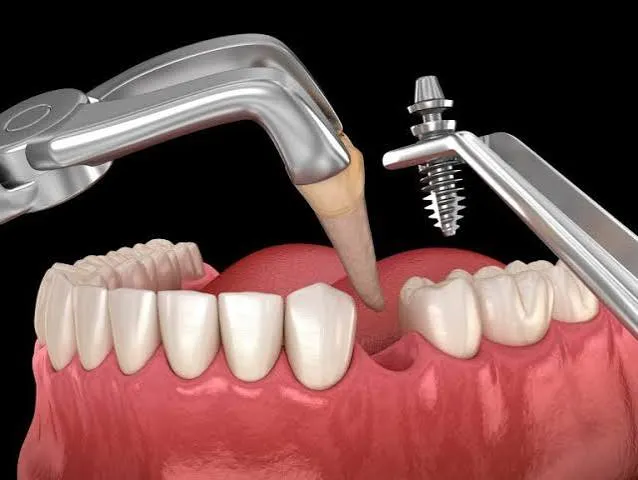 Dental implants 