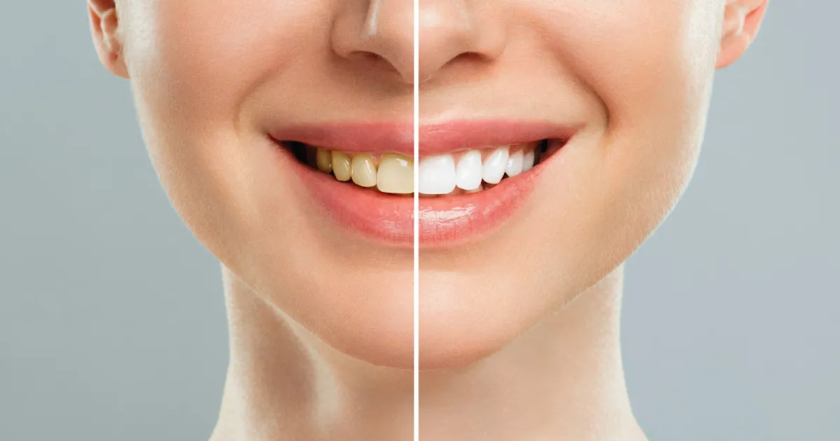 Teeth Whitening Kings Langley: Safe Tips for a Brighter Smile