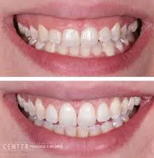 crown lengthening