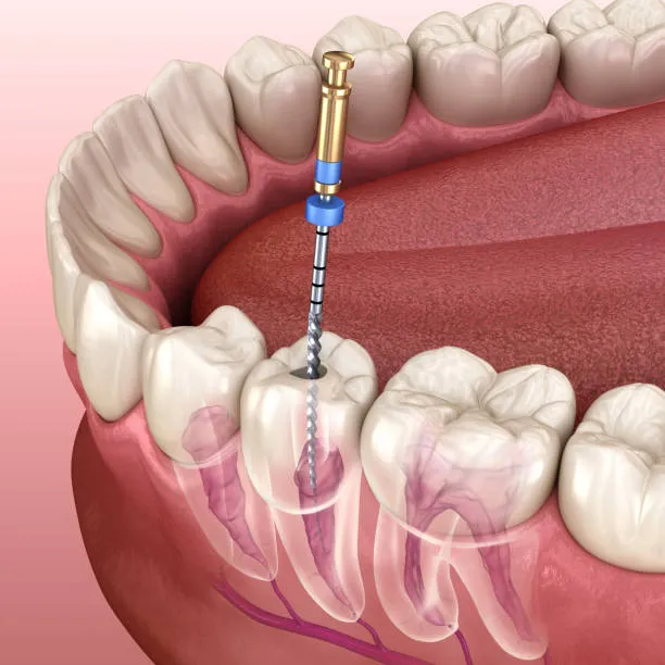 Root Canal Retreatment: When Should You See a Specialist?