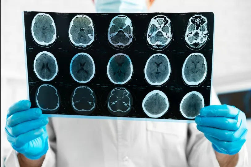 Understanding Traumatic Brain Injury: What Consumers Should Know Before Seeking Legal Help