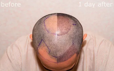 FUE Hair Replacement in 2026: Latest Techniques and Innovations