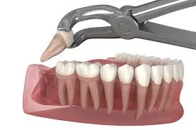 tooth extractions