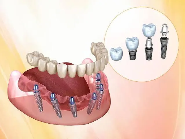 dental implants