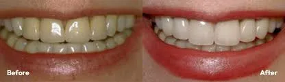 CEREC