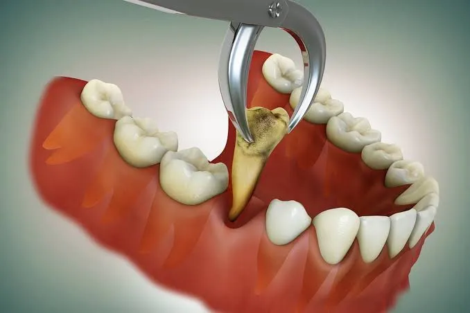 tooth extraction