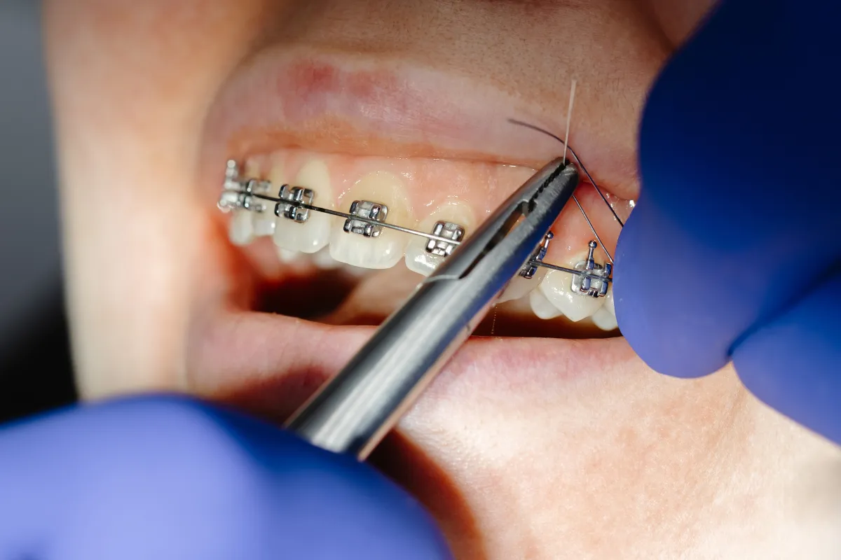 Are Braces Still Better Than Invisalign for Complex Cases?
