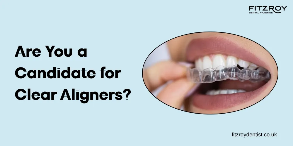 Are You a Candidate for Clear Aligners? What to Know Before You Start in London