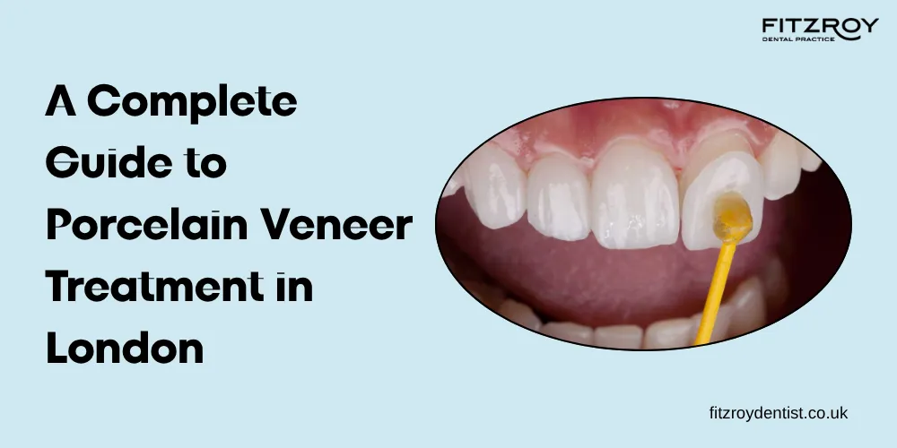 A Complete Guide to Porcelain Veneer Treatment in London