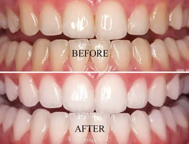 Teeth Whitiening