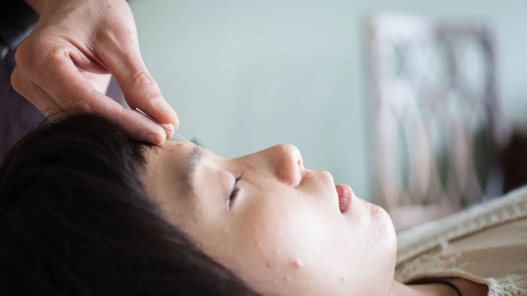 Your First Cosmetic Acupuncture Session in Oakland: What to Expect