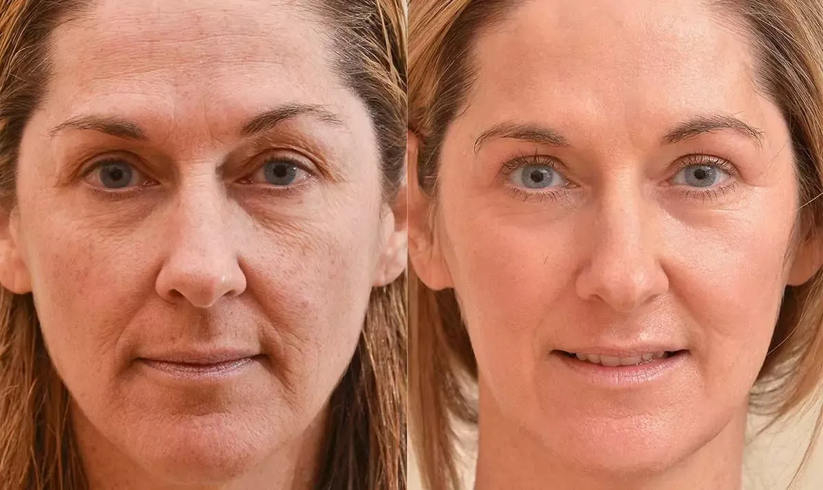 Ablative Laser Resurfacing Cape Town: A Way to Get Smoother, Healthier Skin