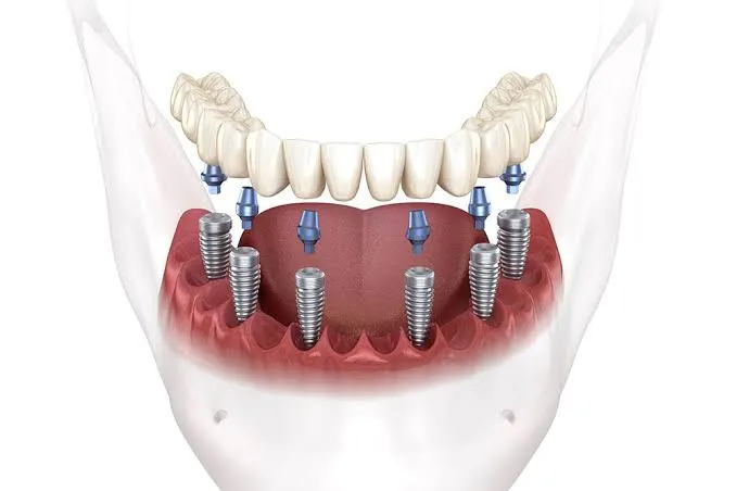 Full mouth dental implant