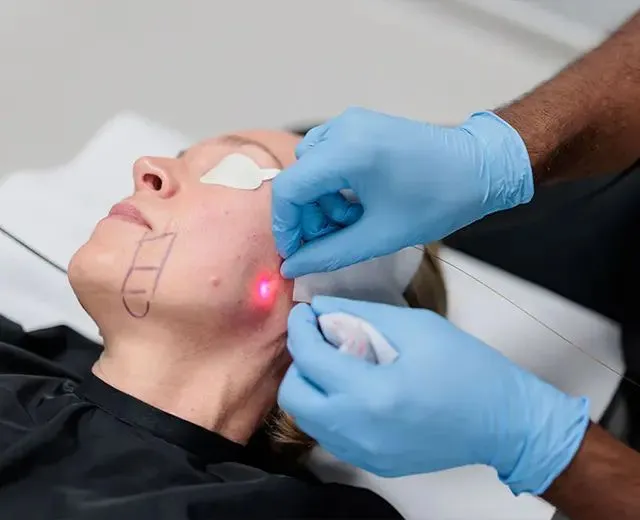 Endolift Treatment in South Delhi