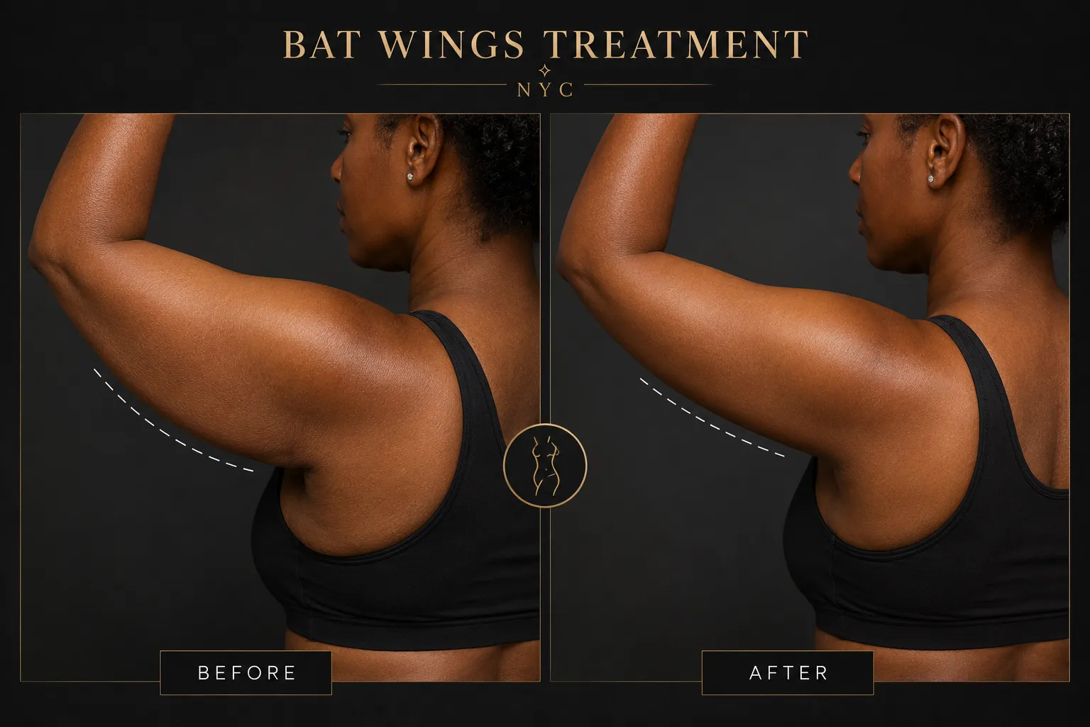 Bat Wings Treatment NYC: Is Body Contouring Right for You?