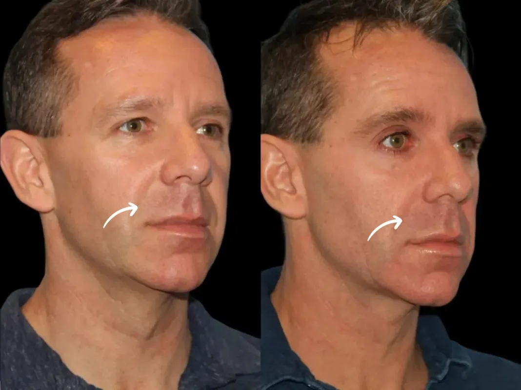 Best Doctors in Dubai for Sculptra Saddlebag Area