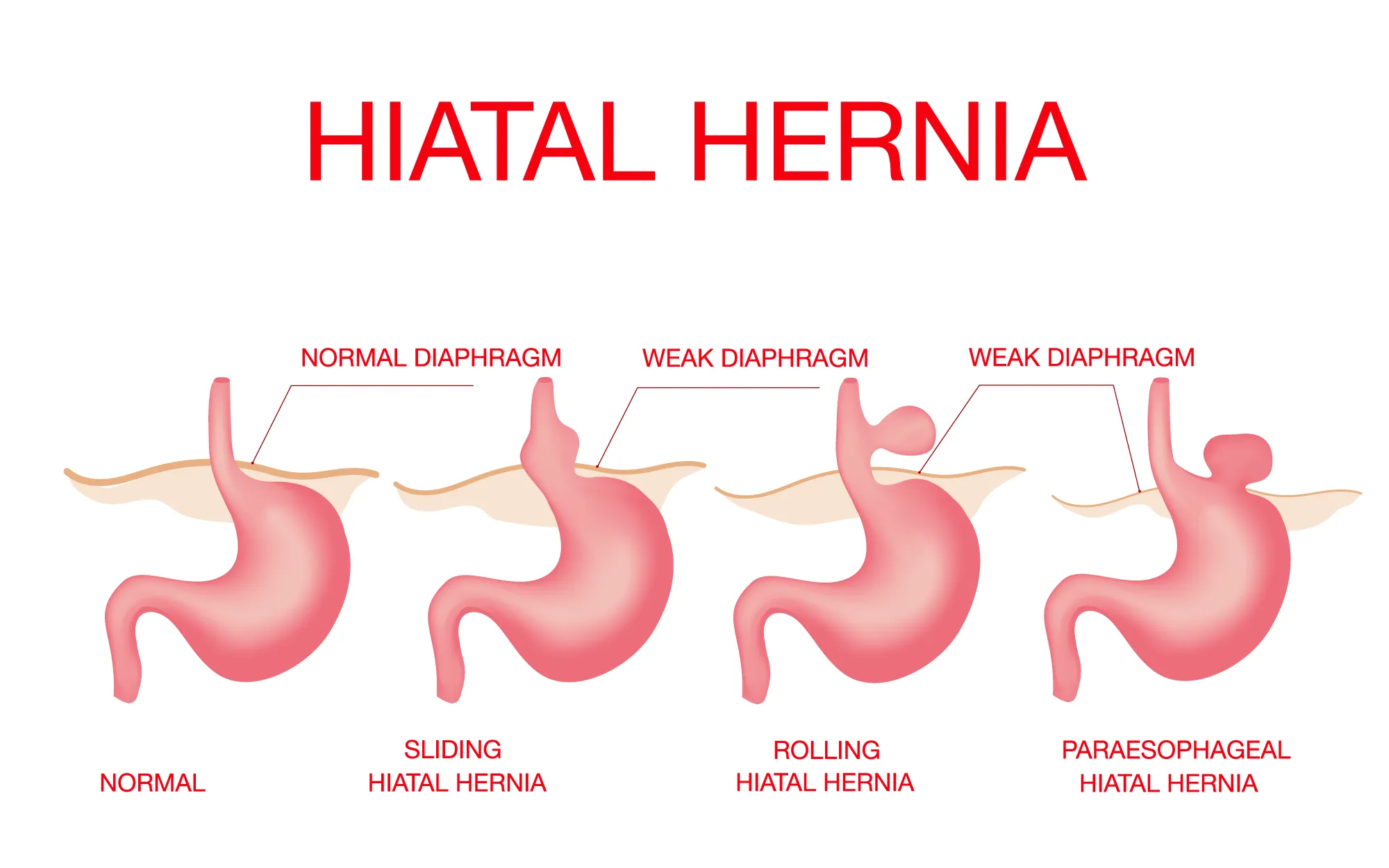 Can Laparoscopic Hernia Repair Help You Return to Normal Life Faster?