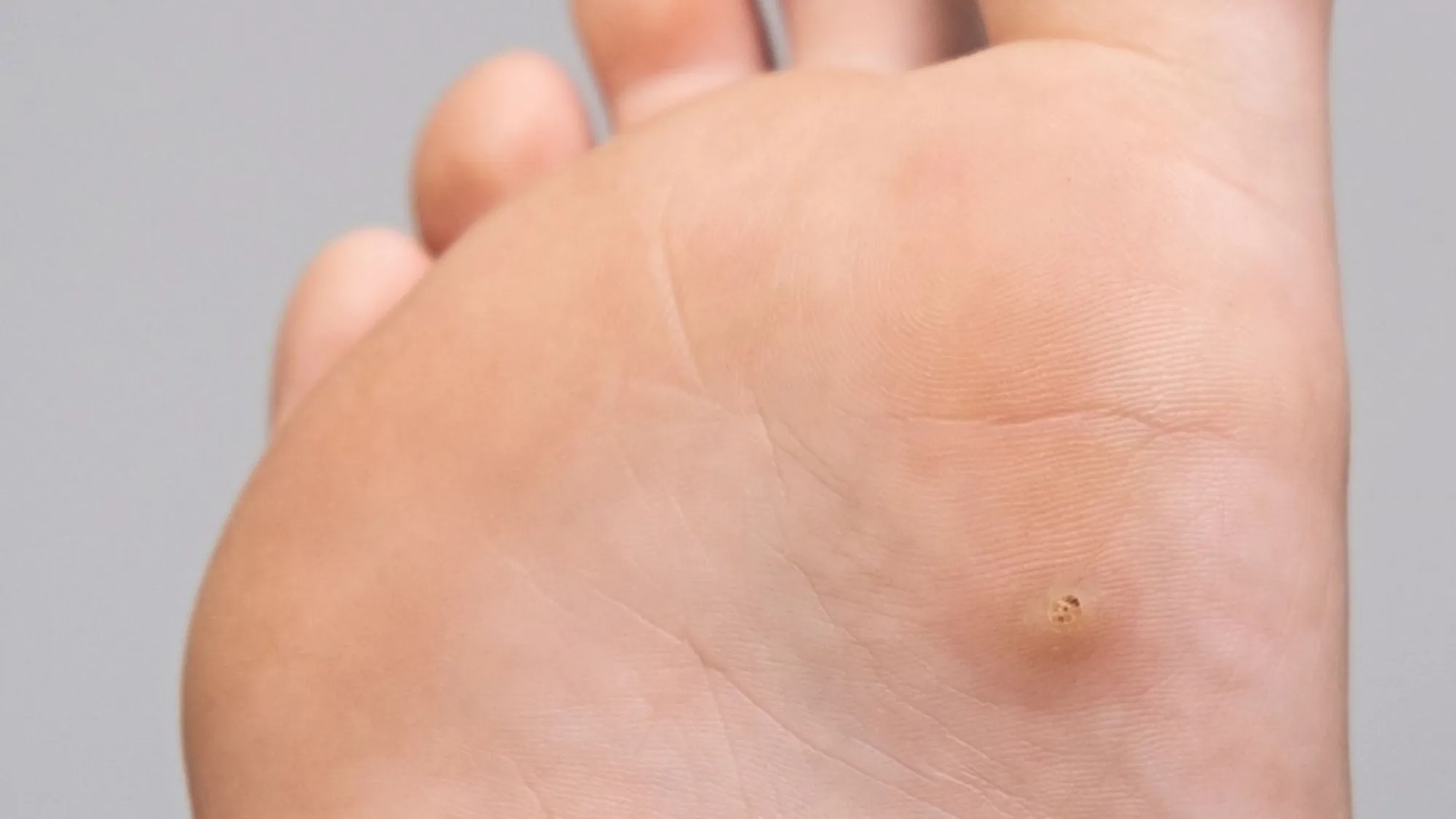 Is Wart Removal Worth the Cost? Benefits and Considerations