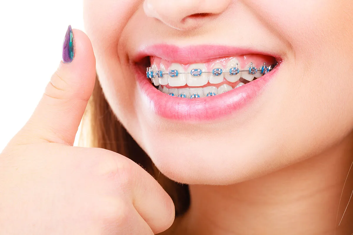 Best Orthodontic Clinic on Sinhgad Road Pune | Braces, Aligners & More