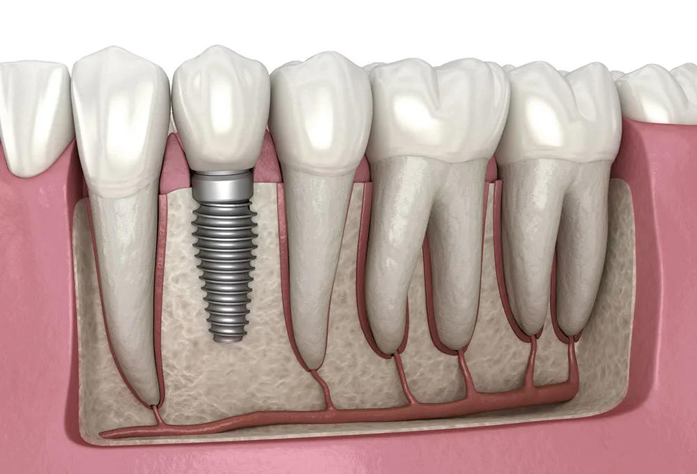 Benefits of Dental Implant Treatment for Missing Teeth
