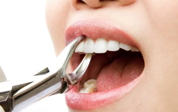 Tooth Extraction What do you have to know