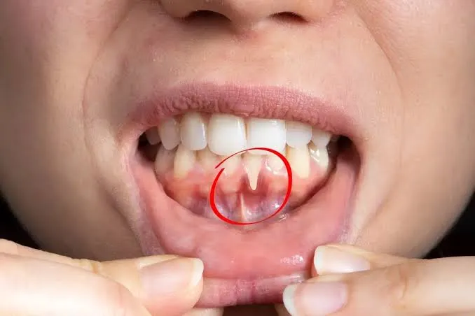 Tooth Extraction What do you have to know
