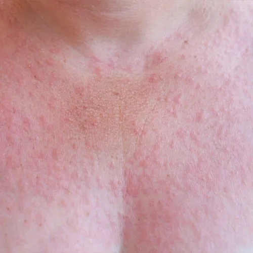 What is Polymorphic Light Eruption? - Dermpro