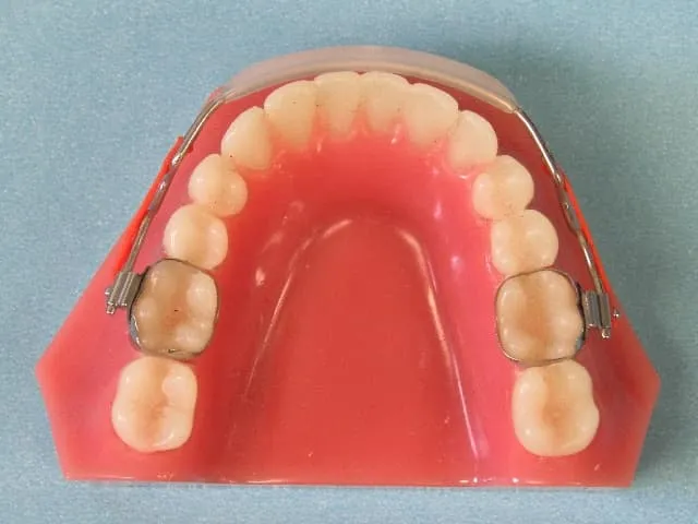 How Habit Correction Appliances Help Children Develop Healthy Oral Habits