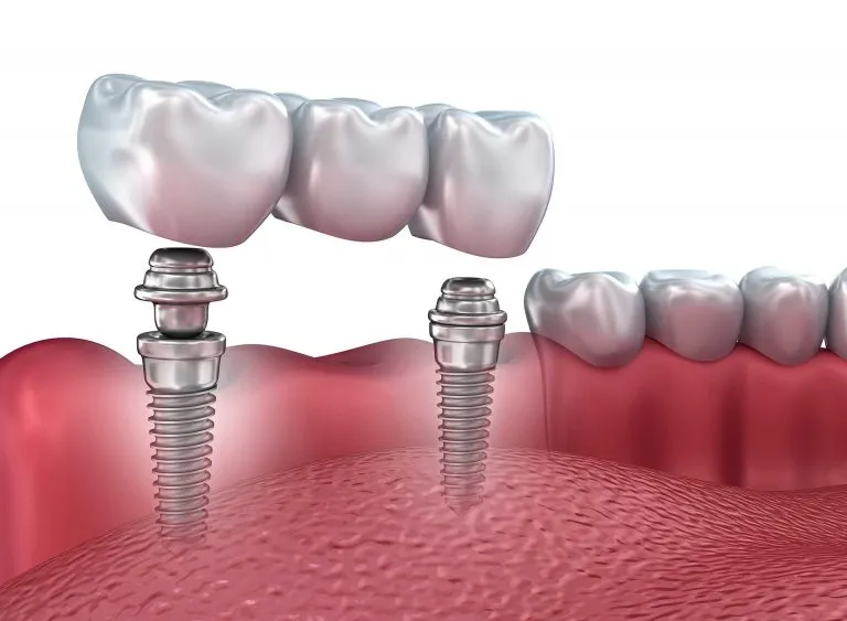 What You Need to Know About Dentures in Hudson, FL?