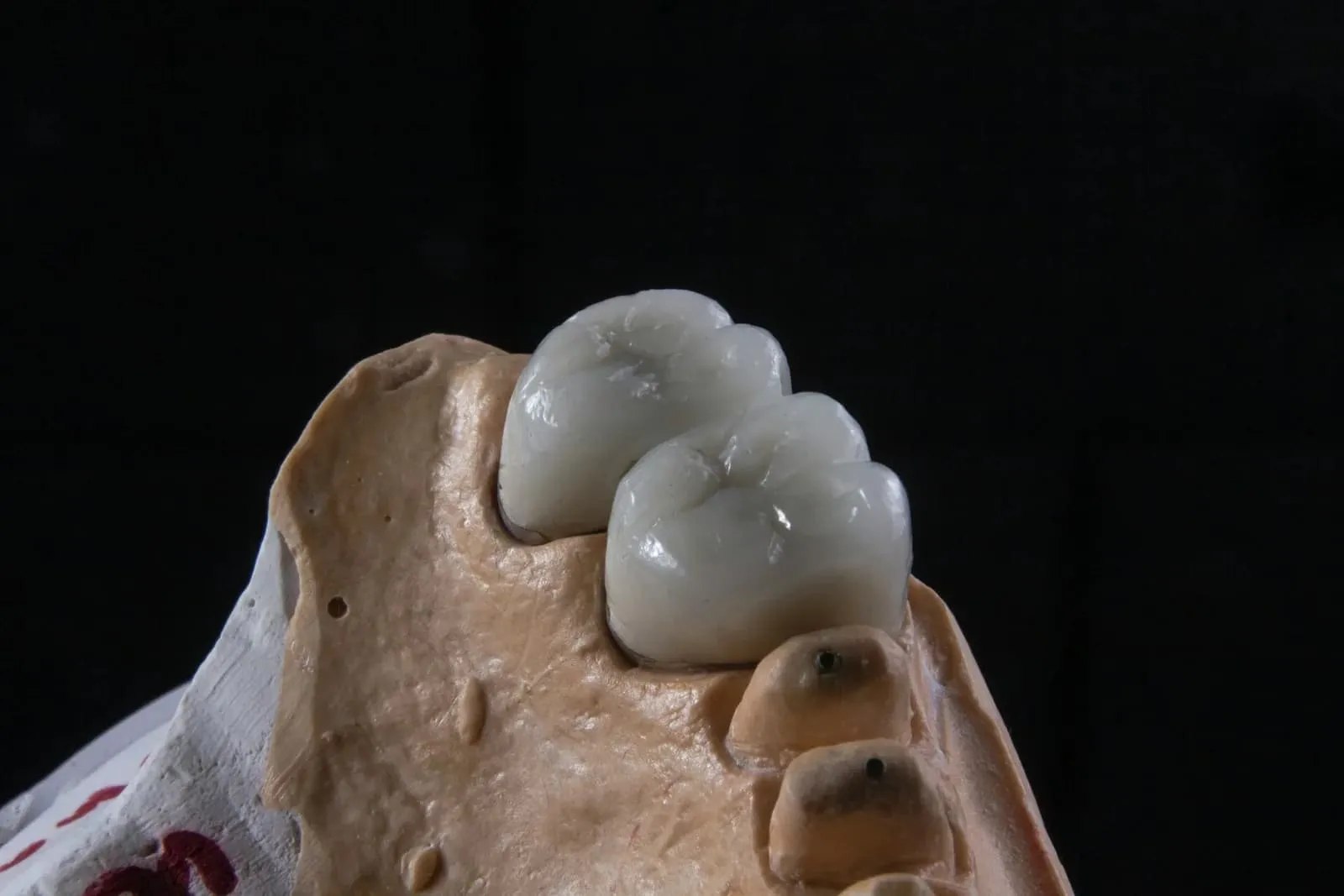 Restore Missing Teeth Comfortably With Durable Dental Bridges Oxnard Solutions