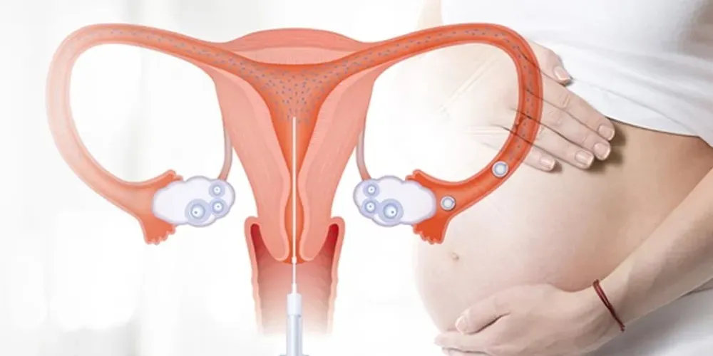 How the Best IUI Hospital Helps Manage PCOS Fertility Challenges