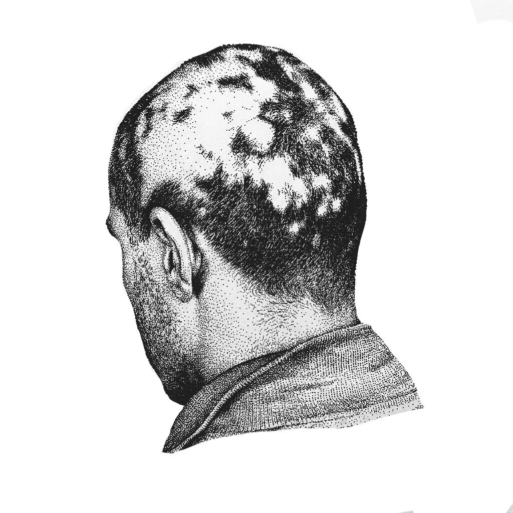 Alopecia Areata: Why Your Hair Falls Out, and How You Actually Get It Back