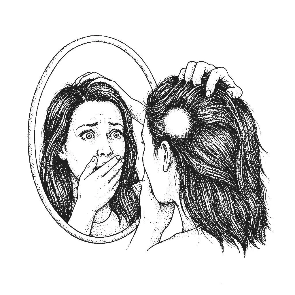 Alopecia Areata: Why Your Hair Falls Out, and How You Actually Get It Back