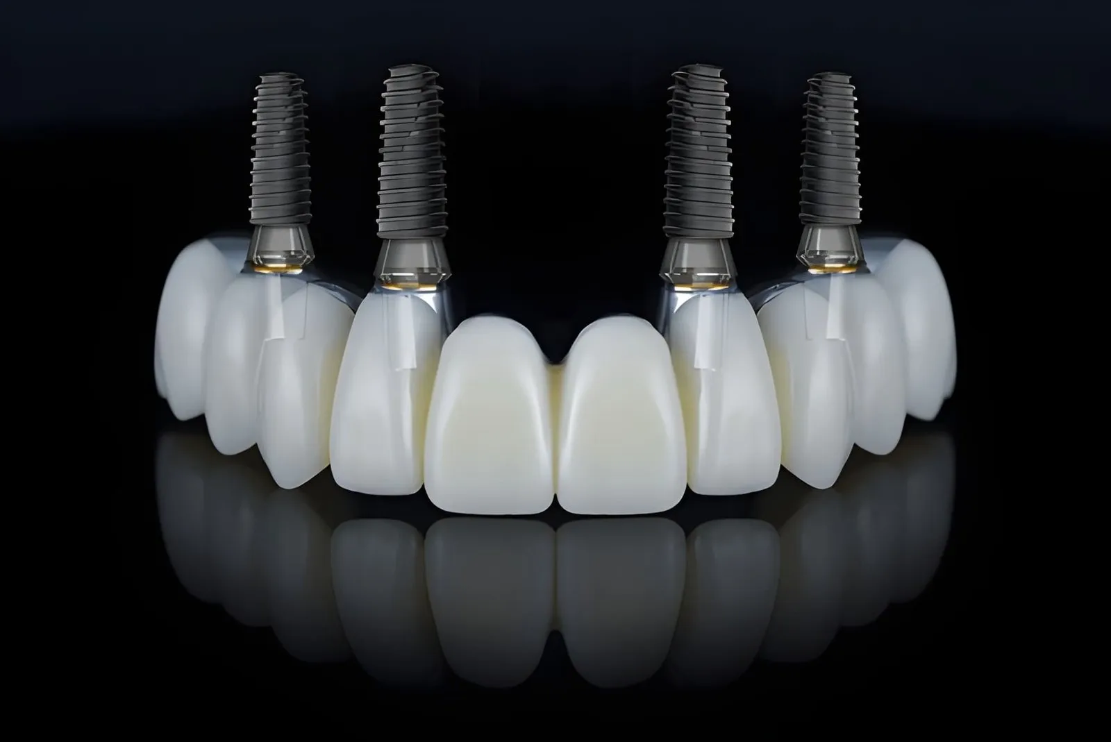The Biggest All-on-4 Dental Implant Mistakes Patients Make and How to Avoid Them
