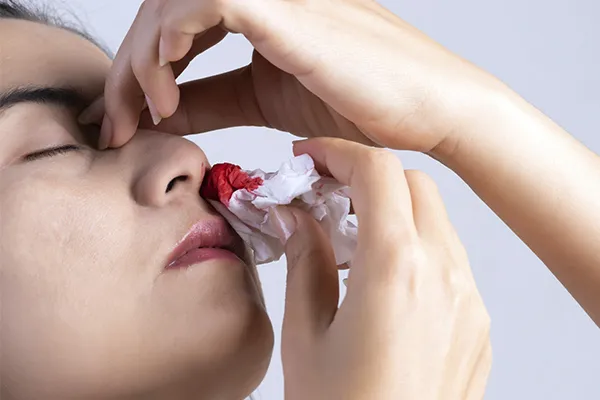 How Specialists Provide Effective Nosebleed Treatment in Sector 43 Gurugram